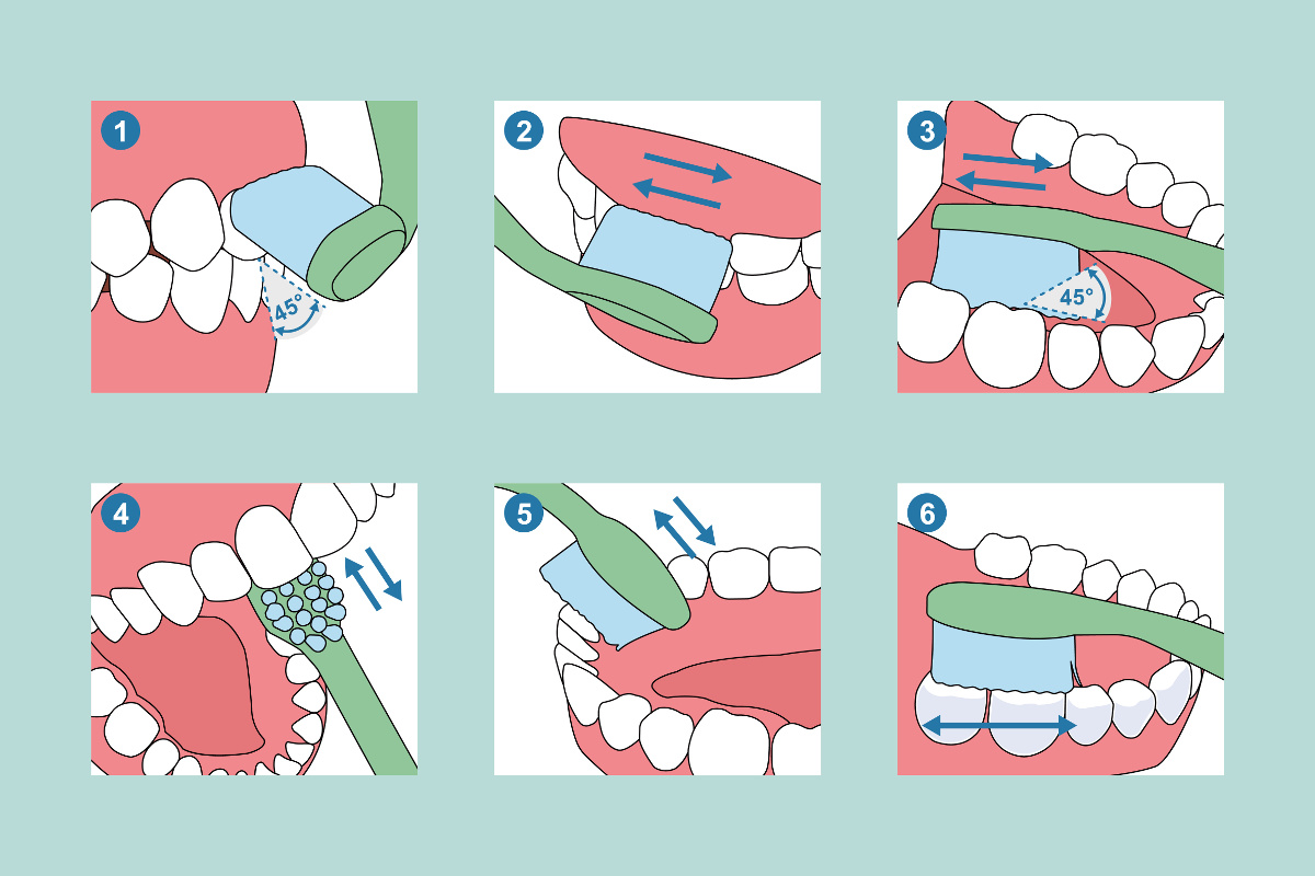 Bass-Technik Zähneputzen Grafik zur Bass-Technik beim Zähneputzen