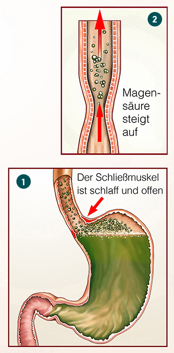 Illustration, die das Entstehen von Sodbrennen erklärt