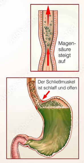 Sodbrennen Sodbrennen